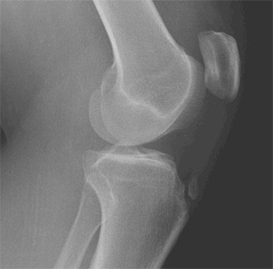 osgood schlatter